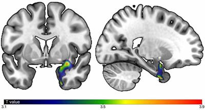 Brain Gray Matter Volume Associations With Abnormal Gait Imagery in Patients With Mild Cognitive Impairment: Results of a Cross-Sectional Study